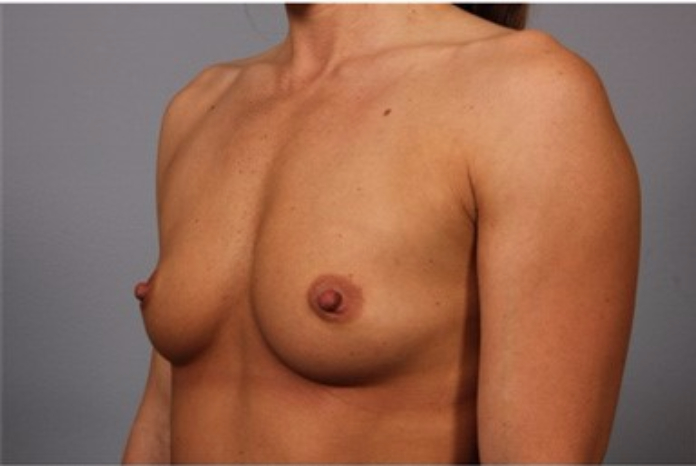 Patient 4 - angled view before breast augmentation