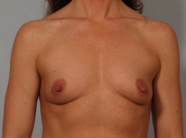Patient 2 - Front view before breast augmentation