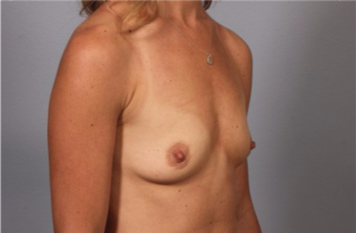 Patient 7 - side view before breast augmentation