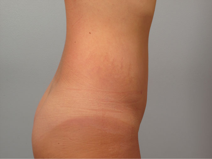 Patient 1 - sideview after liposuction