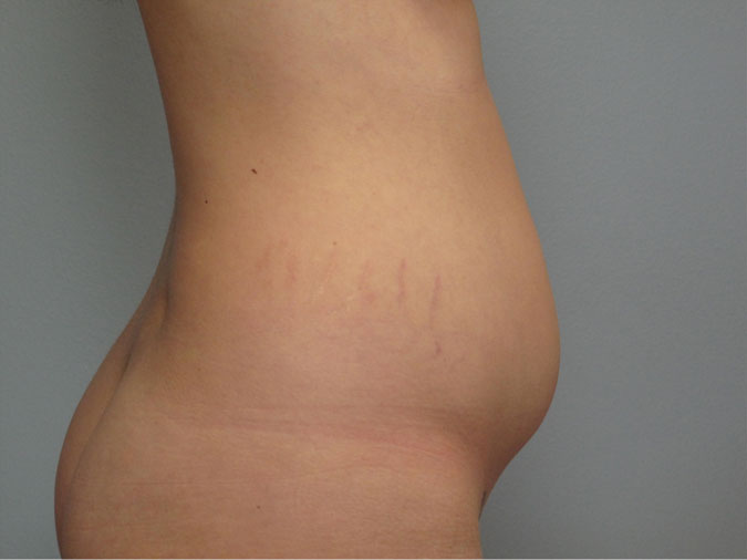 Patient 1 - sideview before liposuction