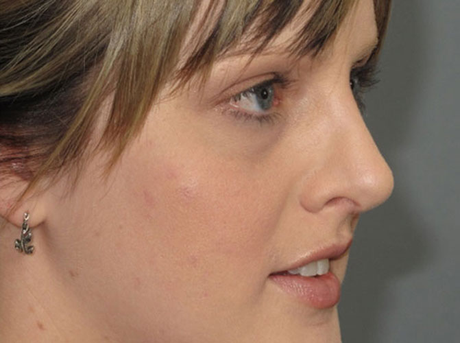 Rhinoplasty Nose Reshaping by Plastic Surgical Assoicates in Fort Collins
