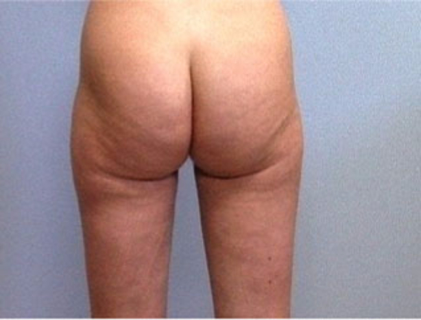 Patient 4 - back view after liposuction for the thighs