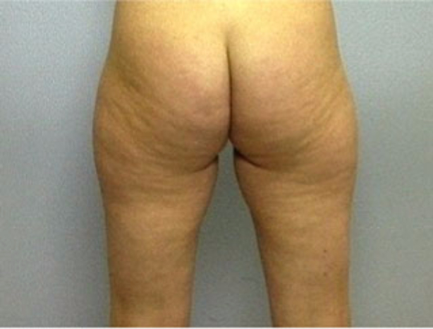 Patient 4 - back view before liposuction for the thighs