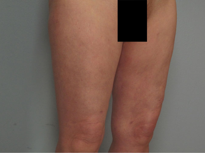 Patient 5 - angled view after liposuction for the thighs