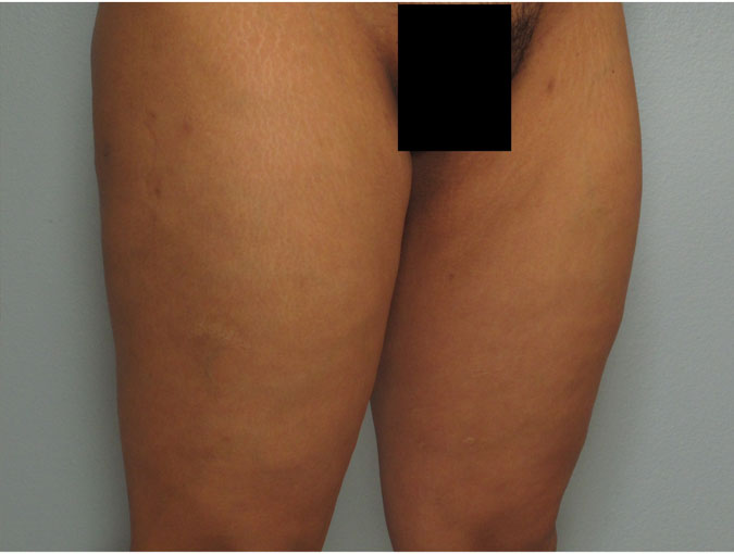 Patient 7 - angled before after liposuction for the thighs