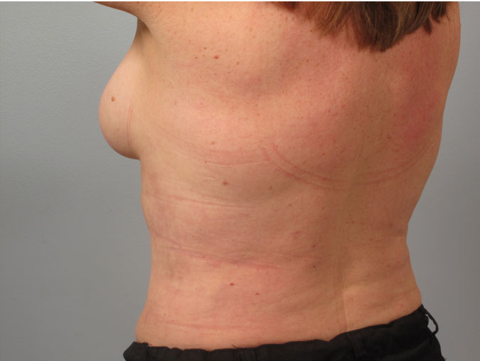 Patient 8 - back view after torso liposuction