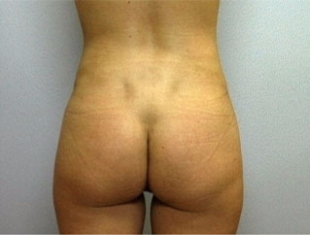 Patient 9 - back view after torso liposuction