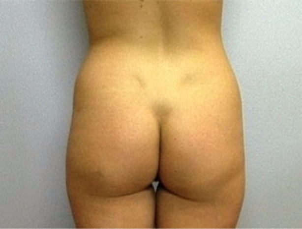 Patient 9 - back view before torso liposuction
