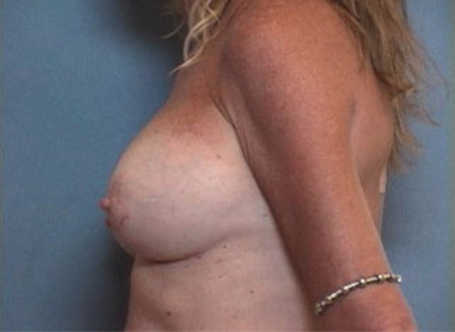 Breast Augmentation patient