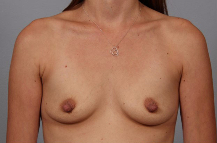 Patient 12 - front view before breast augmentation