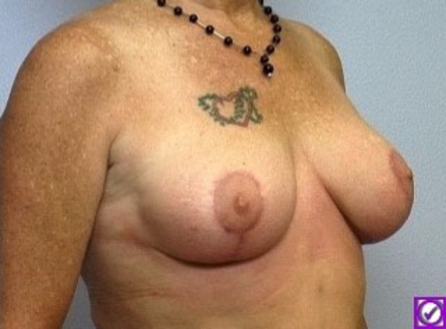 Breast Lift patient