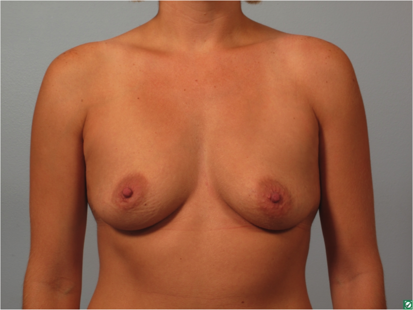 12xa breast augmentation