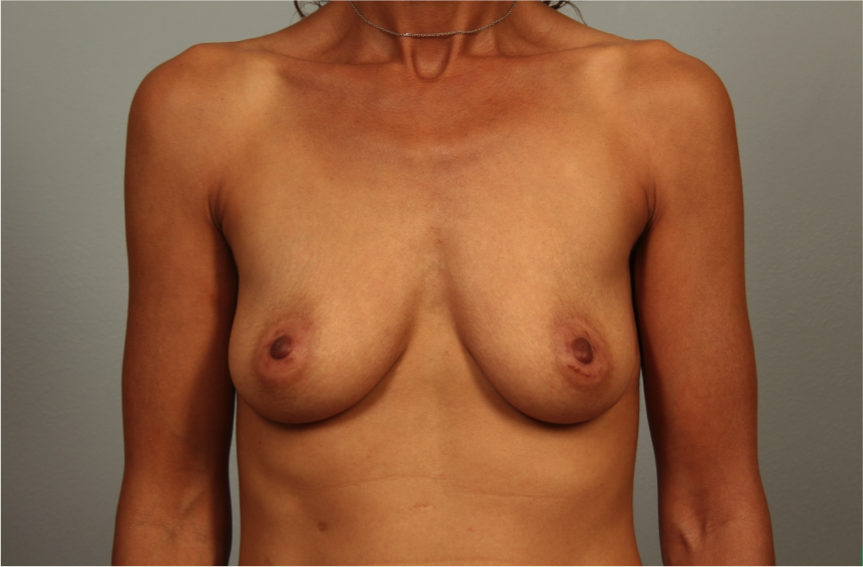 49 year old woman after weight loss