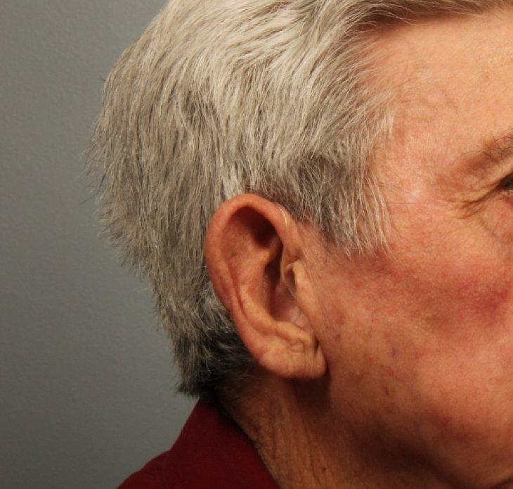 80 year old earlobe reduction after