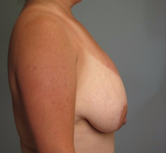 breast Reduction before