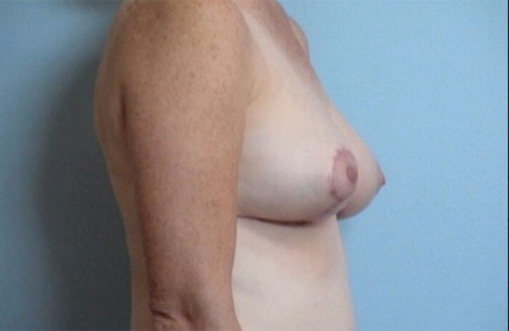 breast Reduction after