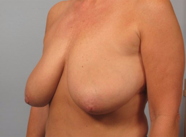 breast Reduction before