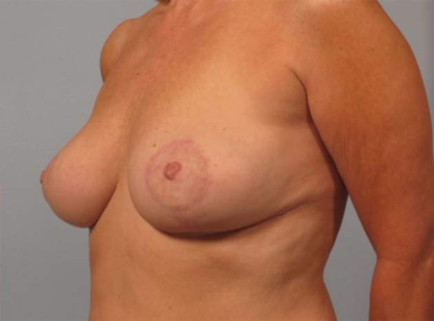 breast Reduction after
