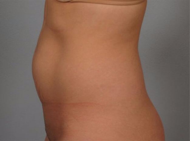 Tummy Tuck Patient Before