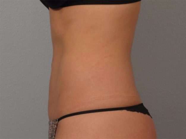 Tummy Tuck Patient After