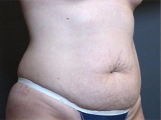 Tummy Tuck Patient Before