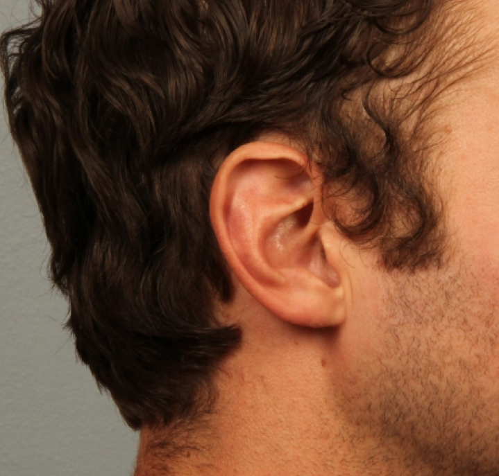 Earlobe reduction after surgery