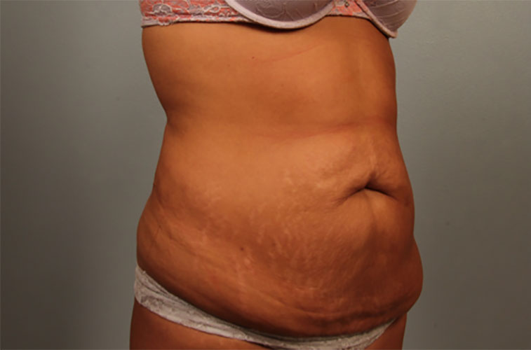 Tummy Tuck (Abdominoplasty) results in Fort Collins by Dr. Duncan