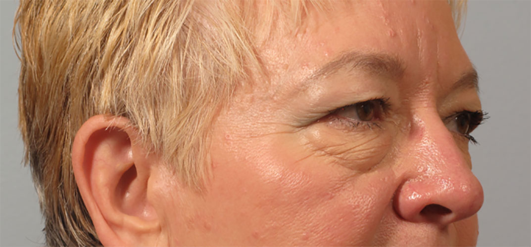 Eyelid surgery results by Plastic Surgical Associates of Fort Collins