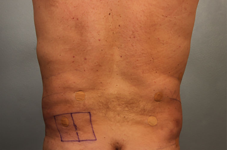 Male body contouring results with liposuction