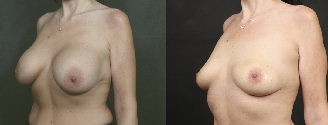 Breast implant removal with Perkylift™