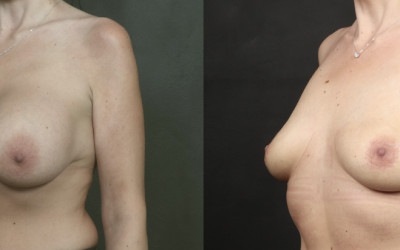 Breast implant removal with Perkylift™