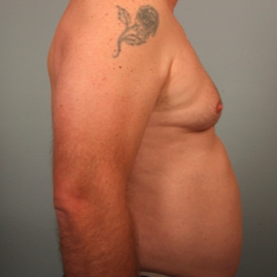 male-breast-case-1