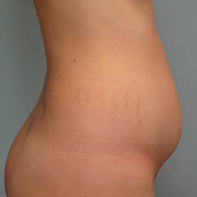 Abdominal plastic surgery and liposuction to achieve a toned abdomen