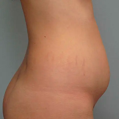 abdominal-bef