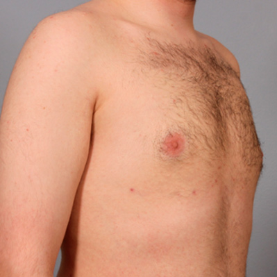 gynecomastia-after