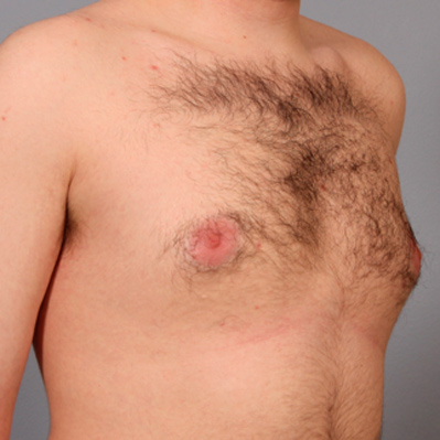 gynecomastia-bef