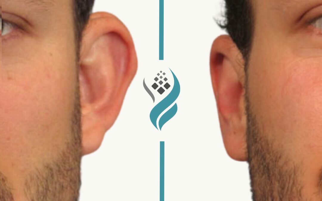 Everything You Need to Know About Ear Pinning Surgery